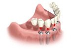 Cherry Hill Dental Excellence | Dental Cleanings and Prevention, Botox for TMJ and Headache Pain and Restorative Dentistry