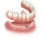 Cherry Hill Dental Excellence | Dental Cleanings and Prevention, Botox for TMJ and Headache Pain and Dental Emergencies