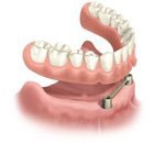 Cherry Hill Dental Excellence | Endodontics, Cosmetic Dentistry and Dental Emergencies