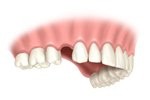Cherry Hill Dental Excellence | Orthodontics, Restorative Dentistry and Botox for TMJ and Headache Pain