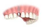 Cherry Hill Dental Excellence | Endodontics, Dental Cleanings and Prevention and Botox for TMJ and Headache Pain