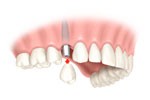 Cherry Hill Dental Excellence | Botox for TMJ and Headache Pain, Orthodontics and Periodontal Disease