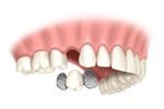 Cherry Hill Dental Excellence | Botox for TMJ and Headache Pain, Oral   Maxillofacial Surgery and Dental Exams and Cleanings