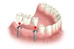 Cherry Hill Dental Excellence | Periodontics, Botox for TMJ and Headache Pain and Periodontal Disease